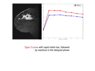 Type 3 curve with rapid initial rise, followed
by washout in the delayed phase
 