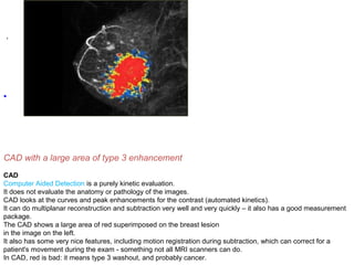 .
•
CAD with a large area of type 3 enhancement
CAD
Computer Aided Detection is a purely kinetic evaluation.
It does not evaluate the anatomy or pathology of the images.
CAD looks at the curves and peak enhancements for the contrast (automated kinetics).
It can do multiplanar reconstruction and subtraction very well and very quickly – it also has a good measurement
package.
The CAD shows a large area of red superimposed on the breast lesion
in the image on the left.
It also has some very nice features, including motion registration during subtraction, which can correct for a
patient's movement during the exam - something not all MRI scanners can do.
In CAD, red is bad: it means type 3 washout, and probably cancer.
 