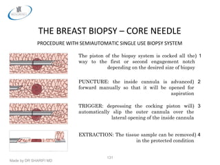 Made by DR SHARIFI MD
131
THE BREAST BIOPSY – CORE NEEDLE
PROCEDURE WITH SEMIAUTOMATIC SINGLE USE BIOPSY SYSTEM
1)The piston of the biopsy system is cocked all the
way to the first or second engagement notch
depending on the desired size of biopsy
2)PUNCTURE: the inside cannula is advanced
forward manually so that it will be opened for
aspiration
3)TRIGGER: depressing the cocking piston will
automatically slip the outer cannula over the
lateral opening of the inside cannula
4)EXTRACTION: The tissue sample can be removed
in the protected condition
i
 