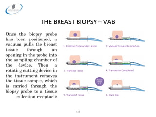 134
THE BREAST BIOPSY – VAB
Once the biopsy probe
has been positioned, a
vacuum pulls the breast
tissue through an
opening in the probe into
the sampling chamber of
the device. Then a
rotating cutting device in
the instrument removes
the tissue sample, which
is carried through the
biopsy probe to a tissue
collection receptacle.
 