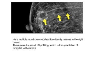 Here multiple round circumscribed low density masses in the right
breast.
These were the result of lipofilling, which is transplantation of
body fat to the breast.
 