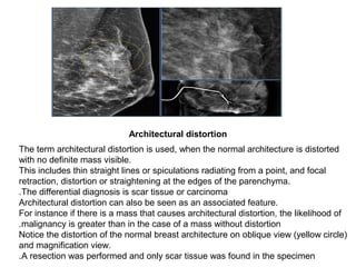 The term architectural distortion is used, when the normal architecture is distorted
with no definite mass visible.
This includes thin straight lines or spiculations radiating from a point, and focal
retraction, distortion or straightening at the edges of the parenchyma.
The differential diagnosis is scar tissue or carcinoma.
Architectural distortion can also be seen as an associated feature.
For instance if there is a mass that causes architectural distortion, the likelihood of
malignancy is greater than in the case of a mass without distortion.
Notice the distortion of the normal breast architecture on oblique view (yellow circle)
and magnification view.
A resection was performed and only scar tissue was found in the specimen.
Architectural distortion
 