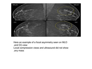 Here an example of a focal asymmetry seen on MLO
and CC-view.
Local compression views and ultrasound did not show
any mass.
 