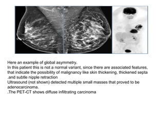 Here an example of global asymmetry.
In this patient this is not a normal variant, since there are associated features,
that indicate the possibility of malignancy like skin thickening, thickened septa
and subtle nipple retraction.
Ultrasound (not shown) detected multiple small masses that proved to be
adenocarcinoma.
The PET-CT shows diffuse infiltrating carcinoma.
 