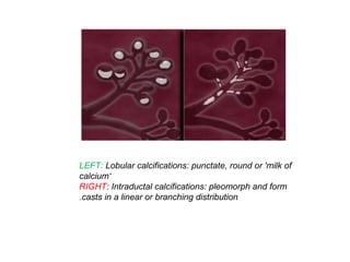 LEFT: Lobular calcifications: punctate, round or 'milk of
calcium‘
RIGHT: Intraductal calcifications: pleomorph and form
casts in a linear or branching distribution.
 