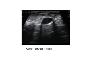 Case 1: BIRADS II lesion
 