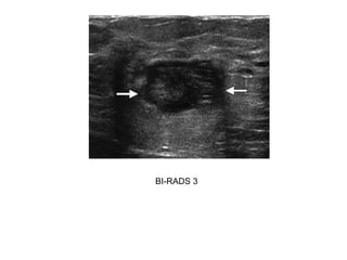 BI-RADS 3
 
