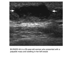BI-RADS 4A in a 55-year-old woman who presented with a
palpable mass and swelling in her left breast
 