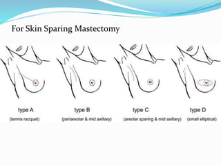 For Skin Sparing Mastectomy
 