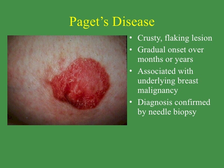 Breast & its diseases