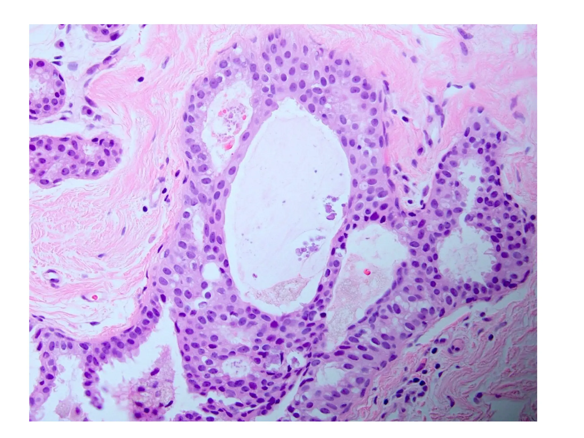 Benign Breast Diseases Pathology Robbins PPTX benign-breast-diseases-pathology-robbins-pptx