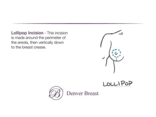 Lollipop Incision Breast lift 101 | PPTX