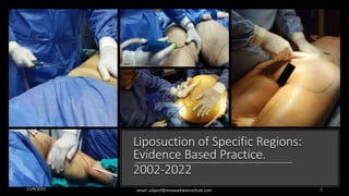 Liposuction of Specific Regions:
Evidence Based Practice.
2002-2022
11/4/2022 email: askprof@moawadskininstitute.com 1
 