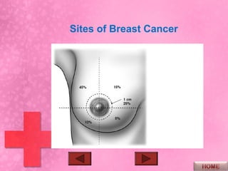 Sites of Breast Cancer
 