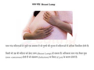 स्तन ग ांठ Breast Lump
स्तन गाांठ महिलाओांसे जुड़ी एक समस्या िै जो पुरुषों की तुलना में महिलाओांमें िह क हसकहसत िोती िैं।
हकसी भी उम्र की महिला को ब्रेस्ट लम्प (Breast Lump) िो सकता िैं। िह कतर स्तन गाांठ कैंसर मुक्त
(non -cancerous) िोती िैं जो सांक्रमण (Infection) या हसस्ट (Cyst) के कारण िोती िैं।
 