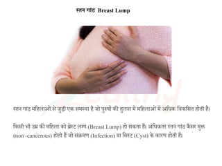 स्तन ग ांठ Breast Lump
स्तन गाांठ महिलाओांसे जुड़ी एक समस्या िै जो पुरुषों की तुलना में महिलाओांमें िह क हसकहसत िोती िैं।
हकसी भी उम्र की महिला को ब्रेस्ट लम्प (Breast Lump) िो सकता िैं। िह कतर स्तन गाांठ कैं सर मुक्त
(non -cancerous) िोती िैं जो सांक्रमण (Infection) या हसस्ट (Cyst) के कारण िोती िैं।
 