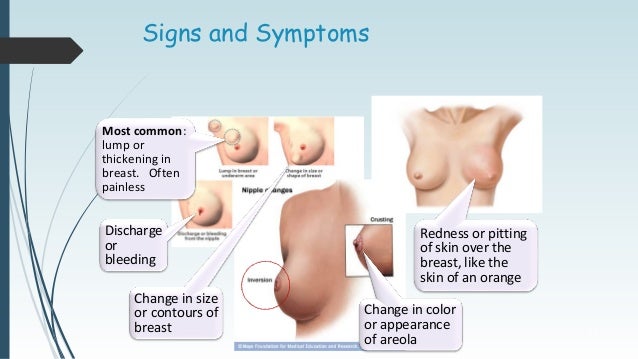 Lumpy Area In Male Breast Bone 42