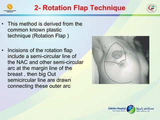 Breast oncoplastic surgery | PPT