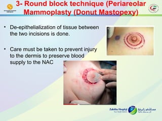 Breast oncoplastic surgery | PPT