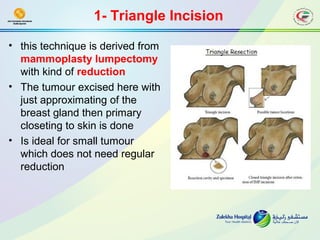 Breast oncoplastic surgery | PPT
