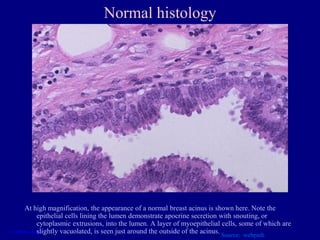 Normal histology




At high magnification, the appearance of a normal breast acinus is shown here. Note the
    epithelial cells lining the lumen demonstrate apocrine secretion with snouting, or
    cytoplasmic extrusions, into the lumen. A layer of myoepithelial cells, some of which are
    slightly vacuolated, is seen just around the outside of the acinus.
                                                                    Source: webpath
 