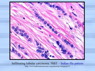 Breast pathology 3 | PPT