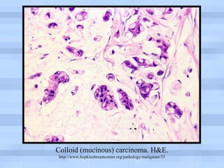 Breast pathology 3 | PPT