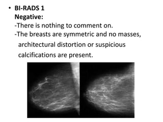 • BI-RADS 1
Negative:
-There is nothing to comment on.
-The breasts are symmetric and no masses,
architectural distortion or suspicious
calcifications are present.
 