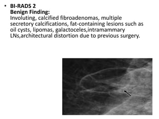 • BI-RADS 2
Benign Finding:
Involuting, calcified fibroadenomas, multiple
secretory calcifications, fat-containing lesions such as
oil cysts, lipomas, galactoceles,intramammary
LNs,architectural distortion due to previous surgery.
 
