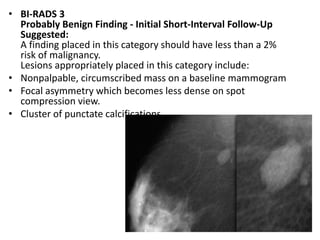 • BI-RADS 3
Probably Benign Finding - Initial Short-Interval Follow-Up
Suggested:
A finding placed in this category should have less than a 2%
risk of malignancy.
Lesions appropriately placed in this category include:
• Nonpalpable, circumscribed mass on a baseline mammogram
• Focal asymmetry which becomes less dense on spot
compression view.
• Cluster of punctate calcifications
 