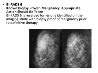 • BI-RADS 6
Known Biopsy Proven Malignancy. Appropriate
Action Should Be Taken
BI-RADS 6 is reserved for lesions identified on the
imaging study with biopsy proof of malignancy prior
to definitive therapy.
 