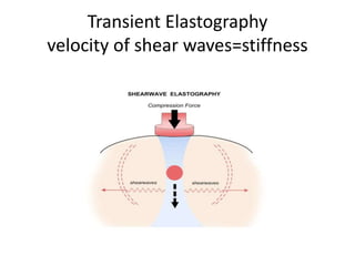 Transient Elastography
velocity of shear waves=stiffness
 