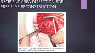 RECIPIENT AREA DISSECTION FOR
FREE FLAP RECONSTRUCTION
 