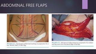ABDOMINAL FREE FLAPS
 