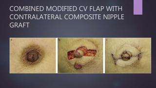 COMBINED MODIFIED CV FLAP WITH
CONTRALATERAL COMPOSITE NIPPLE
GRAFT
 