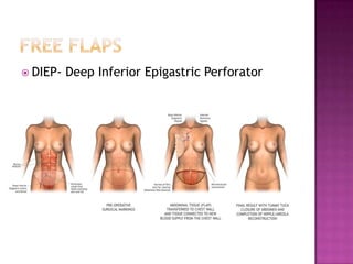  DIEP-   Deep Inferior Epigastric Perforator
 