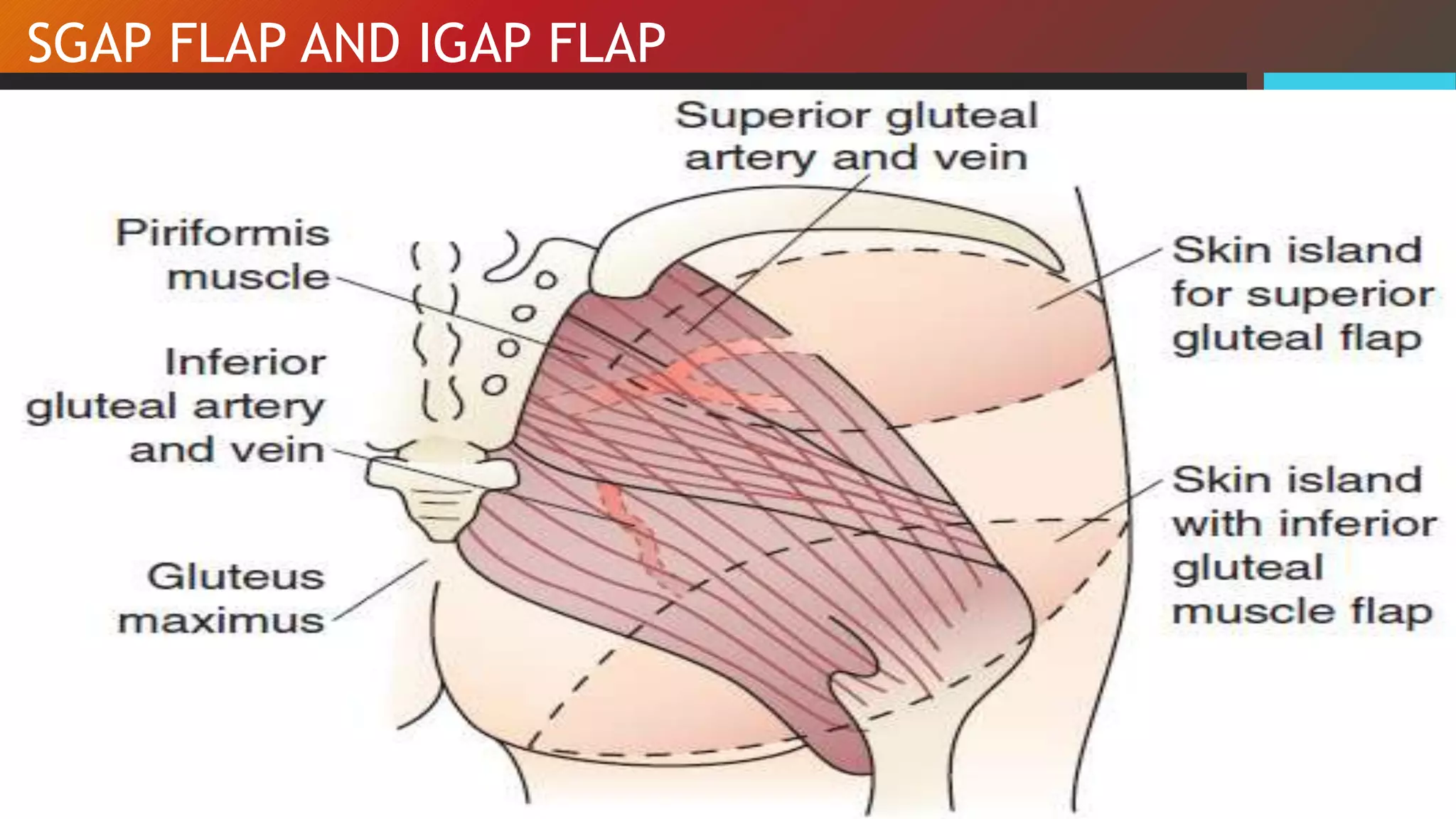 Sgap Breast reconstruction after breast surgery | PPTX