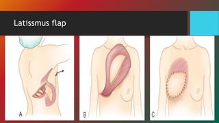 Latissmus flap
 