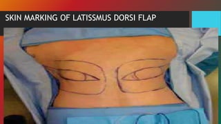 SKIN MARKING OF LATISSMUS DORSI FLAP
 