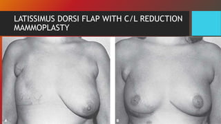 LATISSIMUS DORSI FLAP WITH C/L REDUCTION
MAMMOPLASTY
 