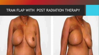 TRAM FLAP WITH POST RADIATION THERAPY
 