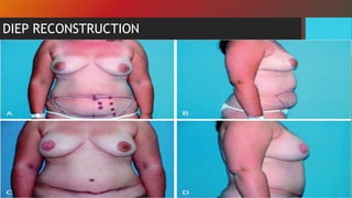 DIEP RECONSTRUCTION
 