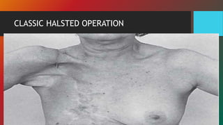 CLASSIC HALSTED OPERATION
 