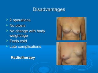DDisadvantagesisadvantages
 2 operations2 operations
 No ptosisNo ptosis
 No change with bodyNo change with body
weight/ageweight/age
 Feels coldFeels cold
 Late complicationsLate complications
RadiotherapyRadiotherapy
 