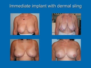 Immediate implant with dermal slingImmediate implant with dermal sling
 