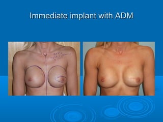 Immediate implant with ADMImmediate implant with ADM
 
