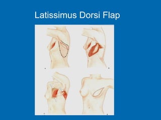 Latissimus Dorsi Flap
 
