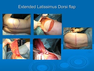 Extended Latissimus Dorsi flapExtended Latissimus Dorsi flap
 