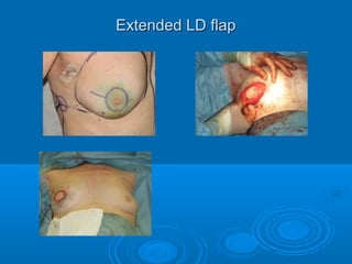 Extended LD flapExtended LD flap
 