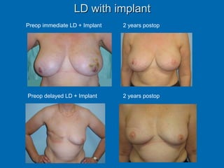 LD with implantLD with implant
Preop immediate LD + Implant 2 years postop
Preop delayed LD + Implant 2 years postop
 